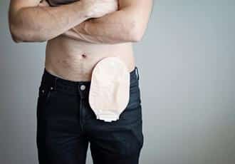 man with colostomy bag