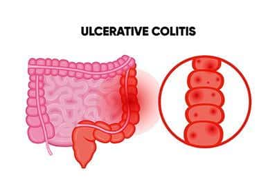 diagram showing ulcerative colitis
