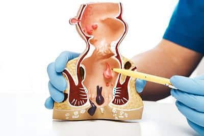 doctor pointing to model of intestine