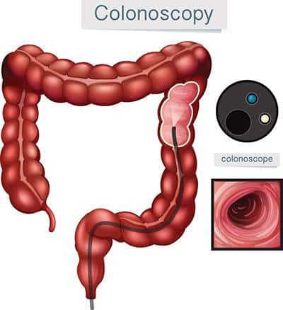diagram of colonoscopy